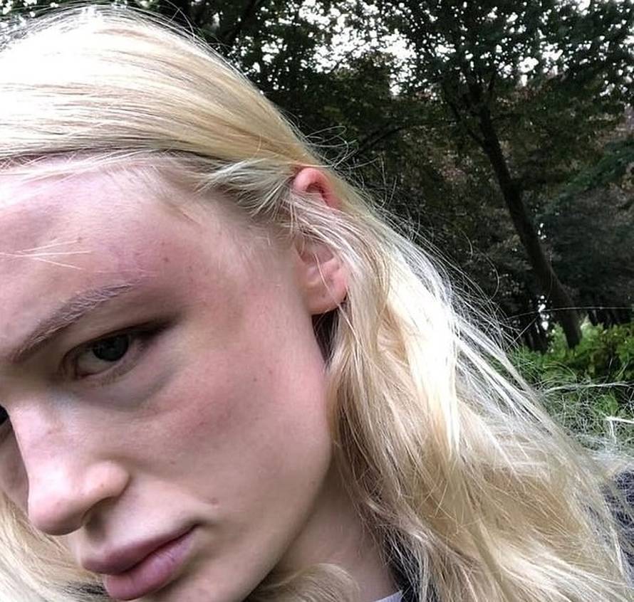 Manekenka je objavila modrice koje joj je nanio dečko: 'Tuga i bol, izlazim jača iz ove veze...'