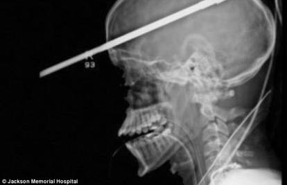 Čudom preživio: Dječaku (16) harpun probio lubanju i mozak