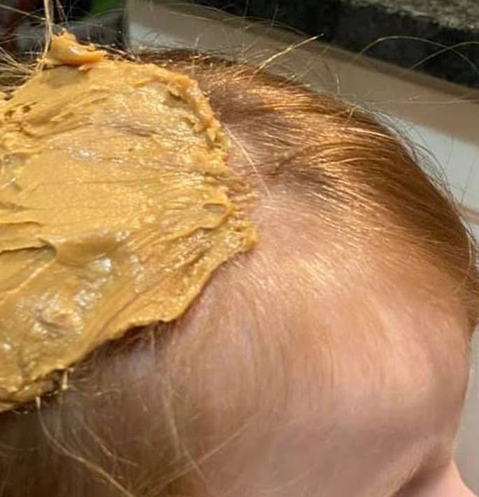 Žvaku zapetljanu u kosi mama je izvukla namazanim maslacem