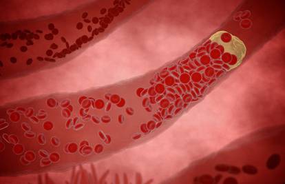 Šest tihih znakova začepljenih arterija: Bolovi u potkoljenici...