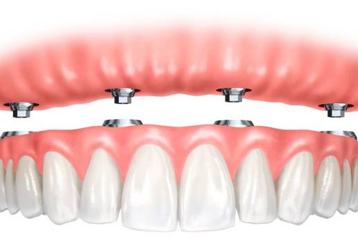 Novi zubi u jednom danu: Kome je rje&scaron;enje namijenjeno?