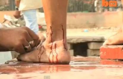 Indija: Režu pacijente žiletima i puštaju im krv jer to liječi rak