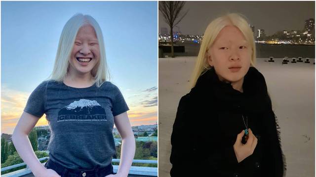 Zbog albinizma su je roditelji ostavili u sirotištu, a danas je zbog svog izgleda traženi model