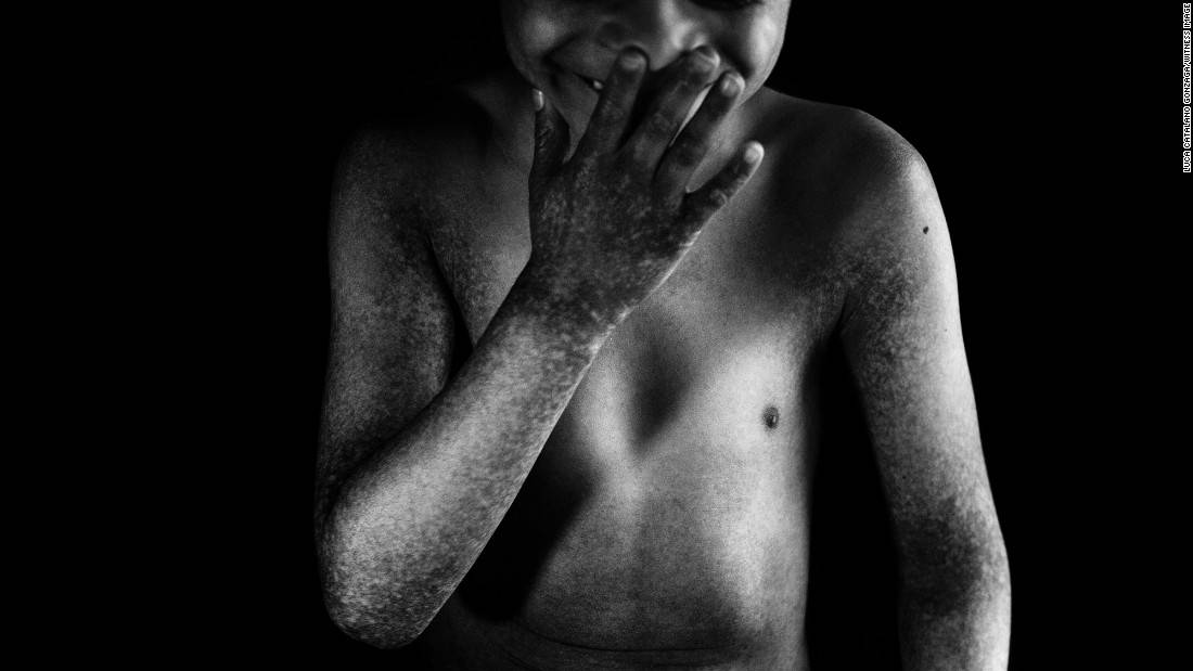 Može umrijeti: Dječak ne smije na svjetlost zbog rijetke bolesti