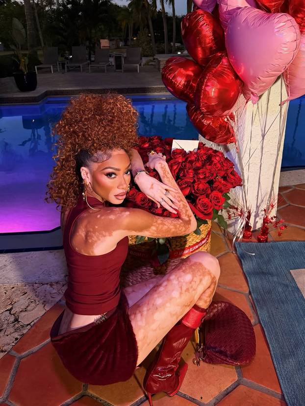 FOTO Rugali su joj se zbog bolesti, a danas je obožavaju zbog jedinstvenog izgleda