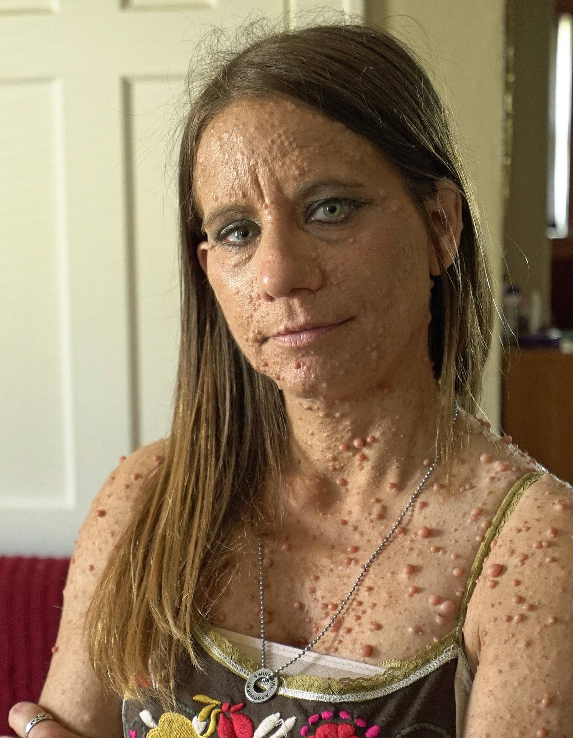 MUM WITH 6000 TUMOURS ON BODY