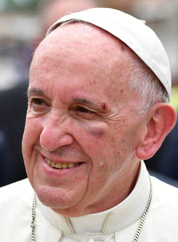 Pope Francis shows a bruise around his left eye during a visit to a neighbourhood in Cartagena