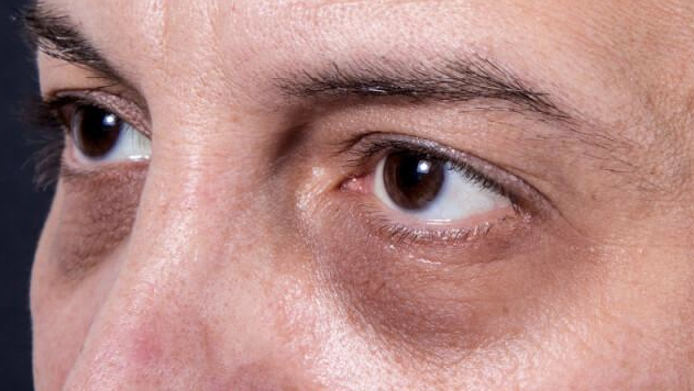 Bezbolno uklonite tamne podočnjake i vrećice ispod očiju