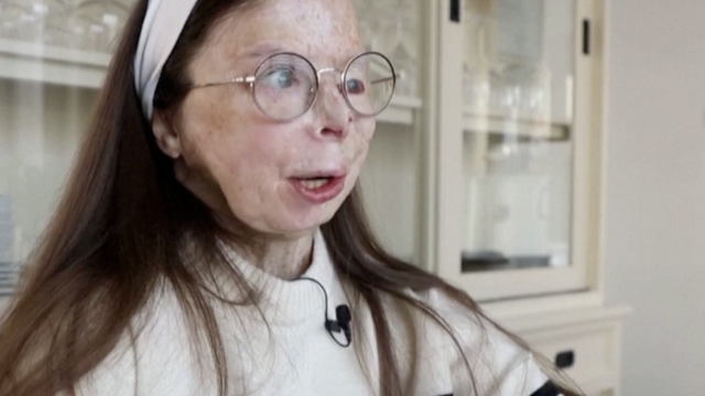 VIDEO Mama preživjela napad kiselinom i postala lice nove kampanje: 'Živim s ružnoćom'