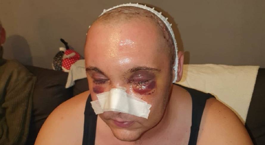 Na slavlju zatražio Škorinu pjesmu, dobio frakturu lubanje