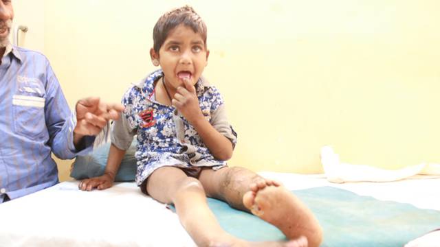 Ne osjećaju bol: Brat i sestra si zbog rijetke bolesti pojeli prste