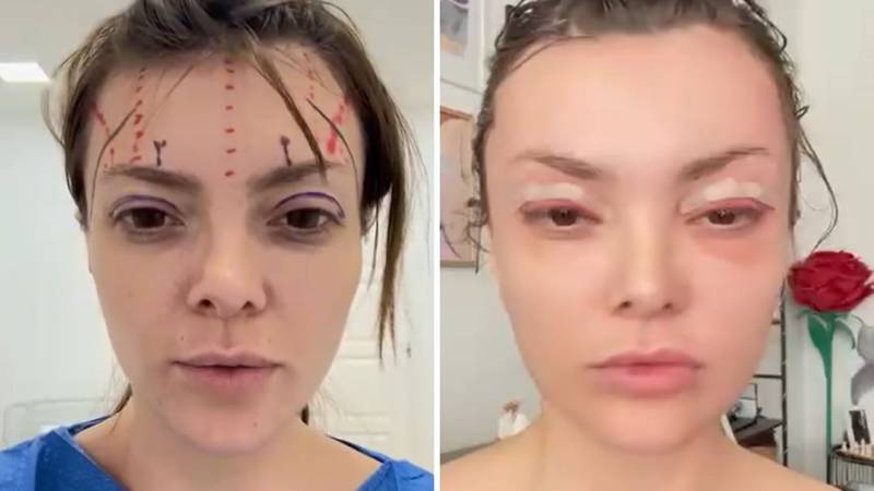 Ella Dvornik ispričala detalje nove estetske operacije: 'Zaklamali su mi glavu...'