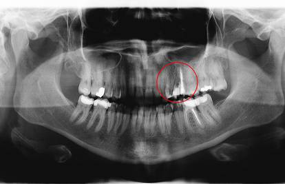 'Izgubila sam zdravi zub, jer je zubar ostavio iglu u korijenu'