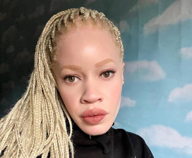 FOTO Afrikanka s albinizmom osvaja modnu industriju: 'Često privlačim znatiželjne poglede'