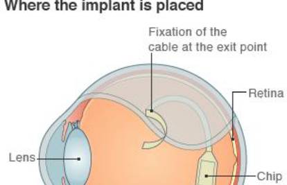 Slijepcu su ugradili posebni čip i djelomično mu vratili vid