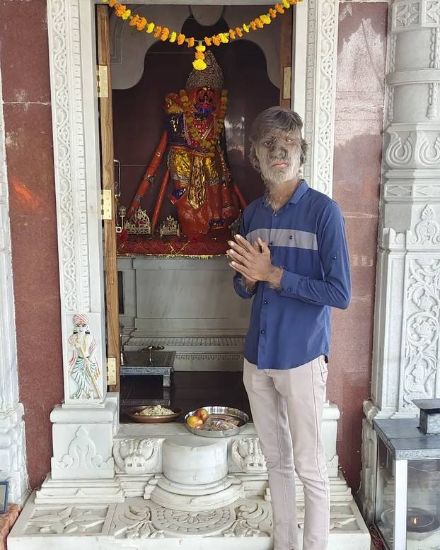 FOTO Ovaj mladić (18) pati od sindroma vukodlaka: U školi me sprdaju, ali volim svoje dlake...