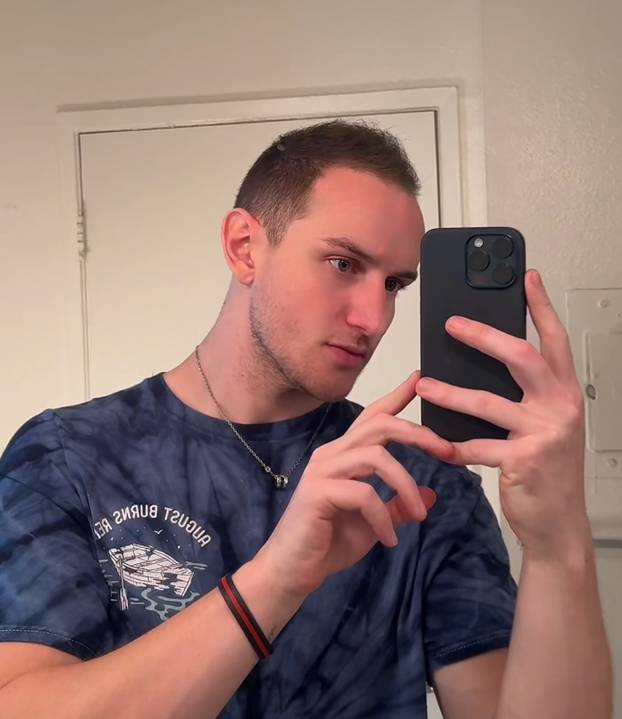 FOTO Stručnjaci o presađivanju kose: 'U Turskoj je to bilo dosta sumnjive kvalitete...'