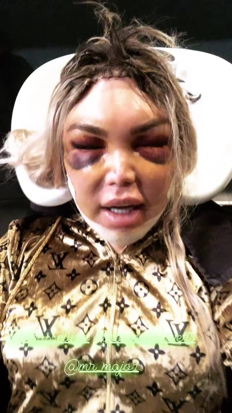 Ljudski Ken opet išao pod nož: Sad ne mogu govoriti ni gledati