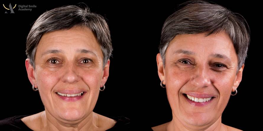 Osmijeh kao iz filma: Možete vidjeti prije kako ćete izgledati