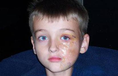 Dječaku (9) odumire lice, a lijek za tu bolest nisu našli