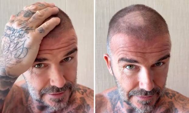 FOTO Stručnjaci o presađivanju kose: 'U Turskoj je to bilo dosta sumnjive kvalitete...'