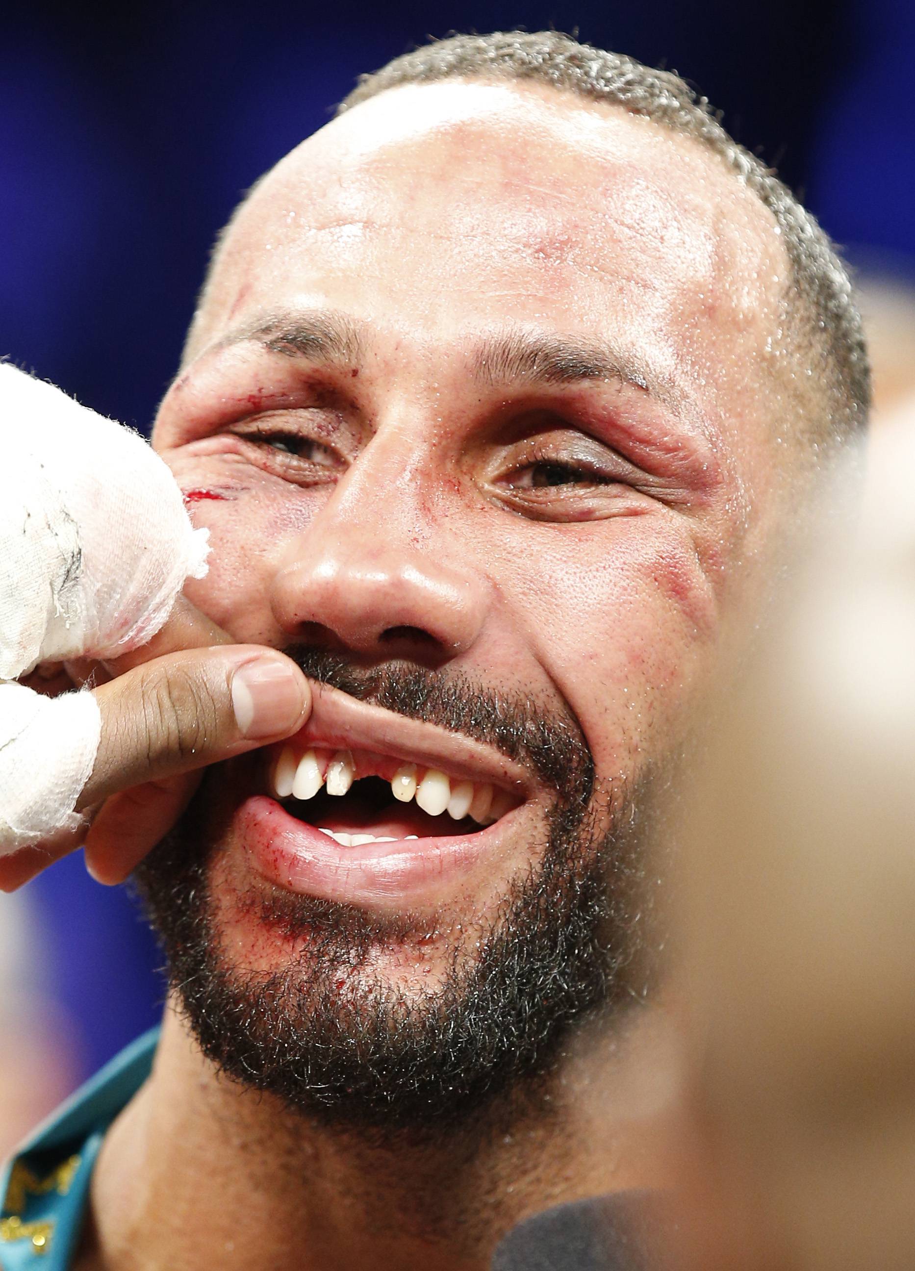 James DeGale reveals missing teeth after the fight