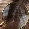 Dermatolog: Perut treba liječiti, jer može izazvati ispadanje kose