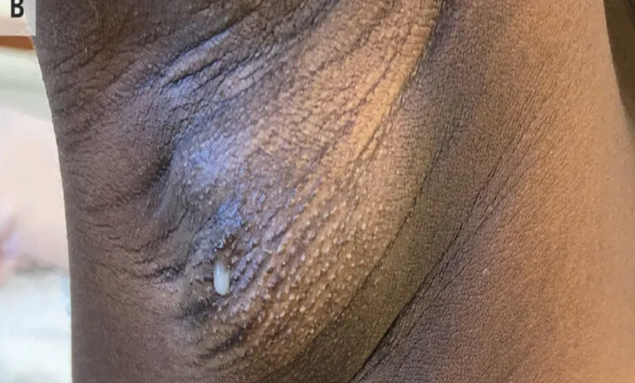 Rijetko stanje: Mami (26) je dva dana nakon poroda počelo curiti mlijeko - ali iz pazuha