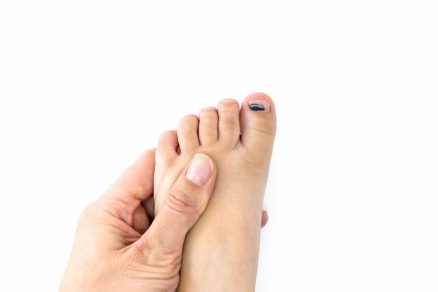Hematoma under the fingernail of the child's toe