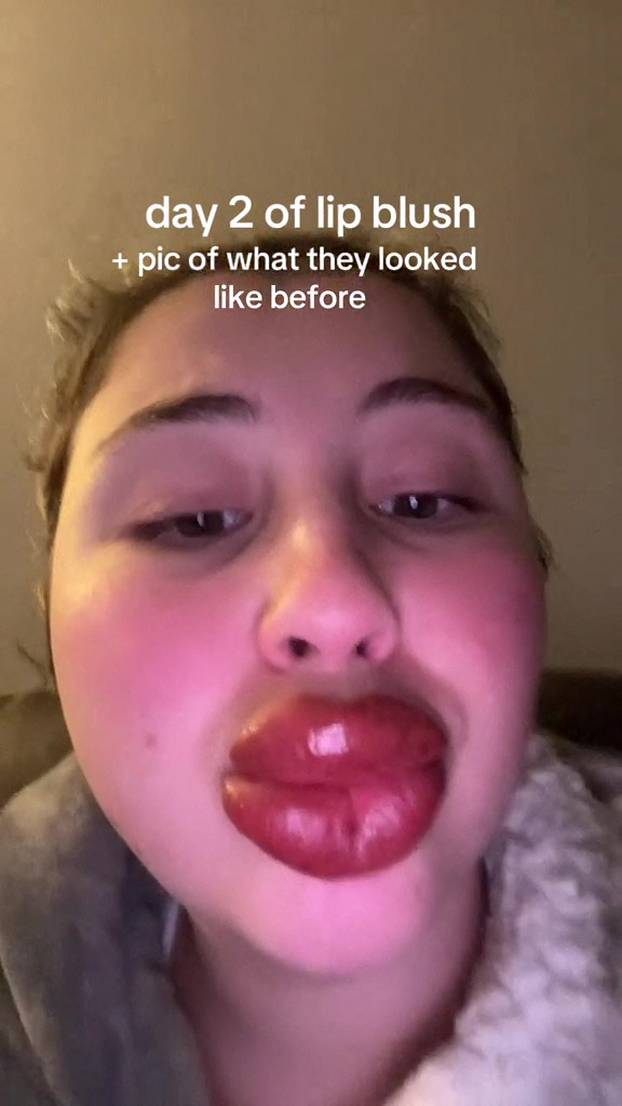 EXCLUSIVE: VIDEO: ‘Extreme allergic reaction to lipstick tattoo left me looking like Monsters Inc character’