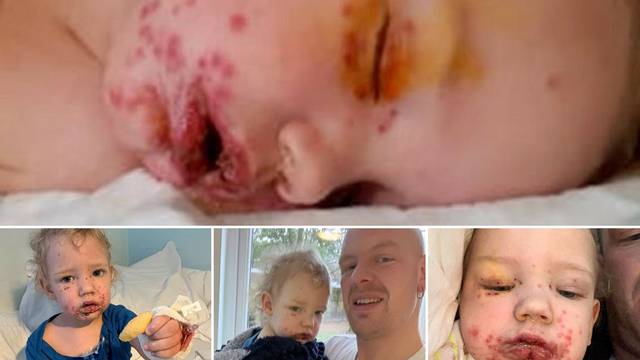 'Poljubac smrti': Dvogodišnjak završio u bolnici zbog herpesa