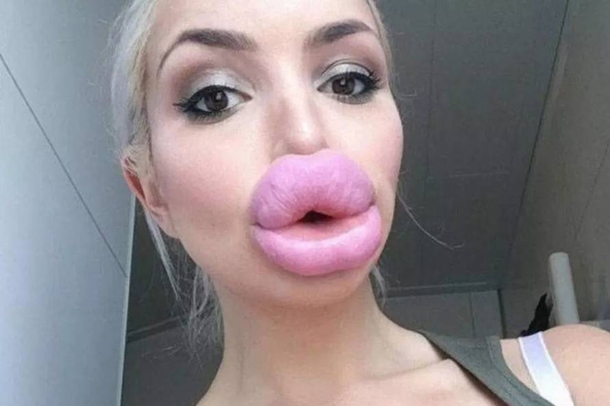 Pretjerale su s filerima: Zovu ih 'jeftinim porno glumicama'