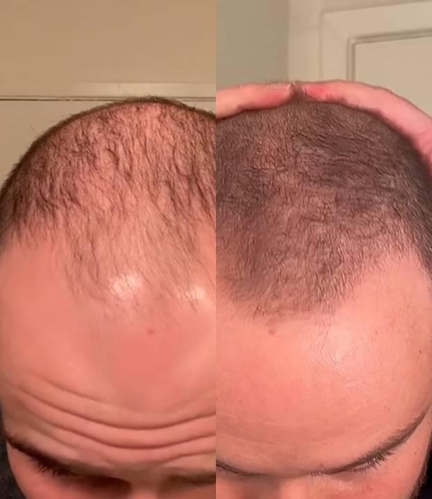 FOTO Stručnjaci o presađivanju kose: 'U Turskoj je to bilo dosta sumnjive kvalitete...'