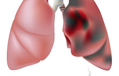 Čak polovica transplantiranih pluća stiže od donora pušača
