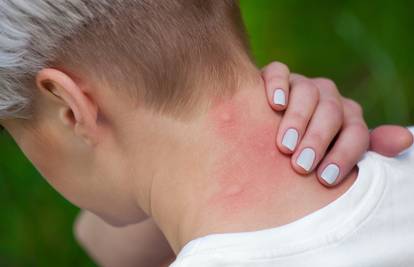 Recept za odbijanje komaraca: Ove mirise nikako ne podnose