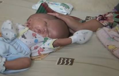 Rodila bebu s dva lica: 'Ne žele ju operirati i spasiti joj život...'