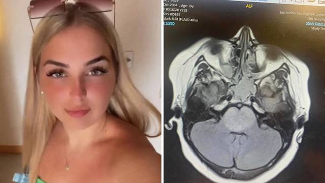 Studentica mislila da je muči mamurluk, u bolnici je doživjela šok: 'Imaš još 12 mjeseci života'