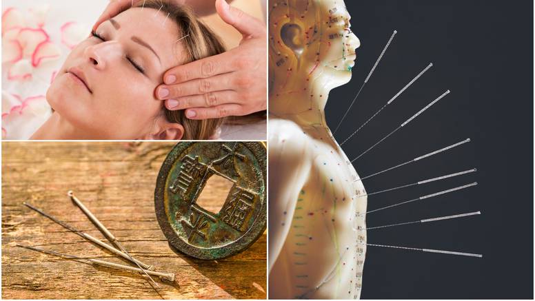 Akupunktura: Ugodno bockanje iglama budi vitalnu energiju