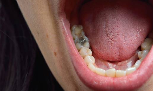 Crne plombe postaju pro&scaron;lost!