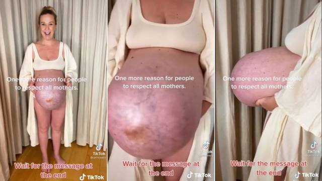 Trudnica je pokazala kako joj izgleda trbuh dok čeka trojčeke, pohvalio ju je i poznati doktor