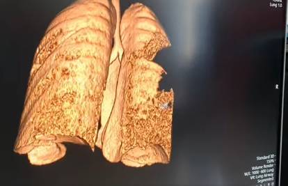 Pulmolog pokazao snimku pluća mladića oboljelog od Covida-19: 'To je potpuna destrukcija tkiva'