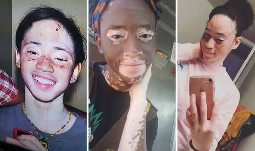 Žena tvrdi da je uspjela vitiligo izliječiti veganskom prehranom