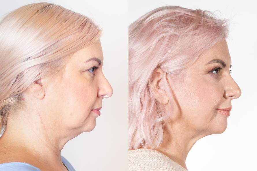 Iva voli 'vampirski tretman', a Alka 'pegla' bore smijalice...