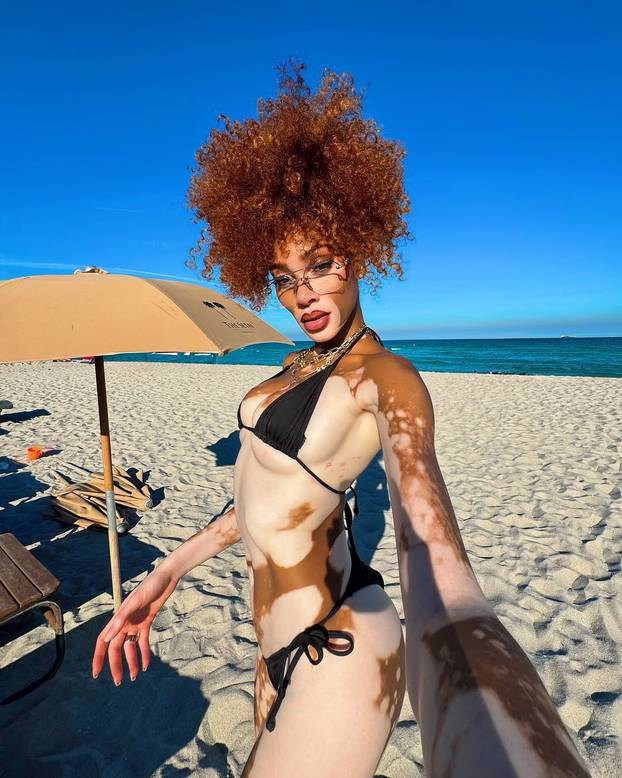 FOTO Rugali su joj se zbog bolesti, a danas je obožavaju zbog jedinstvenog izgleda