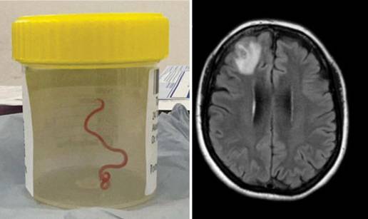Prvi slučaj u svijetu: Ženi su iz mozga izvukli živog crva dugog 8 cm, koji je inače u pitonima