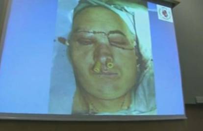 Samo 20 dana nakon nesreće Poljaku (33) presadili cijelo lice
