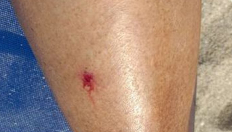 Riba ušata 'napada' kupače u Španjolskoj. Stručnjak: Ugrize li vas, nema ozbiljnih posljedica