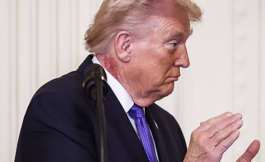 Trump se 'osuo' po vratu, a ima i kraste. Oglasio se liječnik...