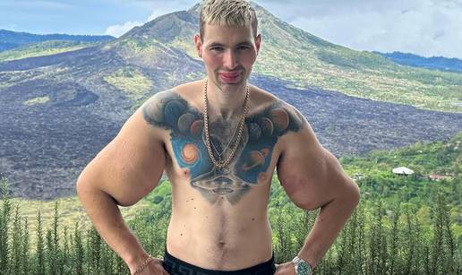 FOTO 'Ruski Popaj' mogao bi izgubiti obje ruke zbog teške infekcije: Ubrizgava kemikalije!