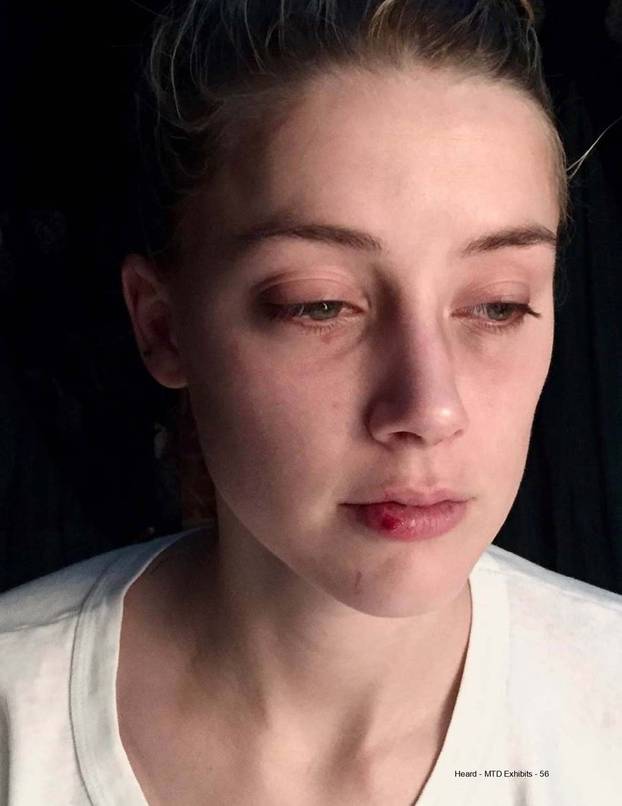 Johnny Depp admits to accidentally headbutting Amber Heard as High Court hearing is shown photos of her injuries from 2015 altercation